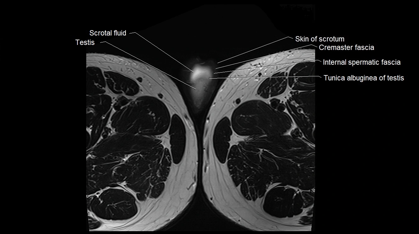 MRI 3T scrotum and penis axial cross sectional anatomy image 41.webp